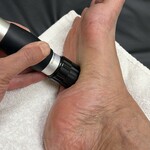 Shockwave treatment to the Plantar Fascia