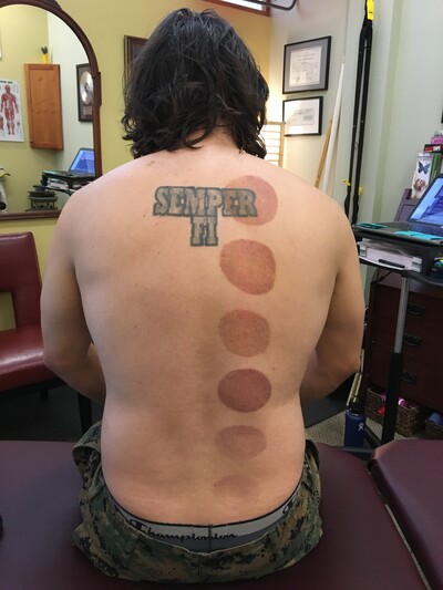 Cupping the back