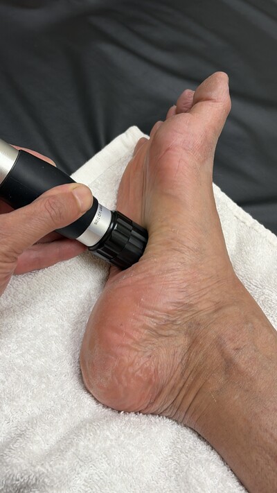 Shockwaving Plantar Fascitis
